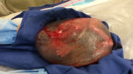 Baby born still INSIDE his amniotic sac