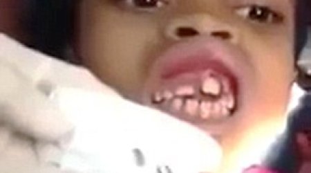 Dentist removing 15 MAGGOTS from inside little girl's gum