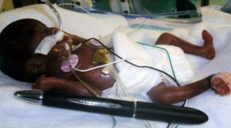 284 qram doğulan qızın son durumu - FOTOLAR