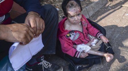 Parents flee Syria with their badly burned little girl