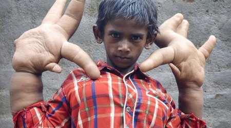 Hope for the boy with the world's biggest hands