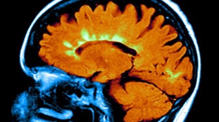 Low vitamin-D genes linked to MS