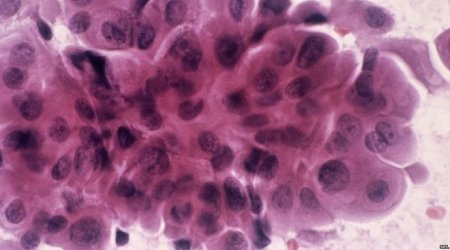 Blood test 'detects cancer relapse'