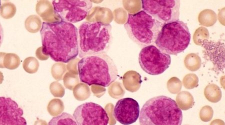 Diabetes drug may help in leukaemia