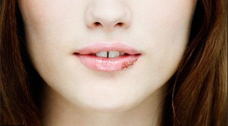 Why YOU'RE likely to have herpes