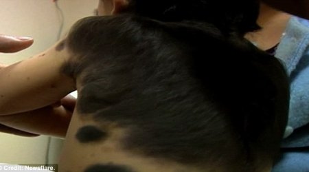 The boy with 'fur' growing on his back