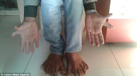 Indian carpenter with world record 28 fingers and toes