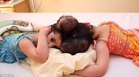 Twin four-year-old girls joined at the head are successfully separated