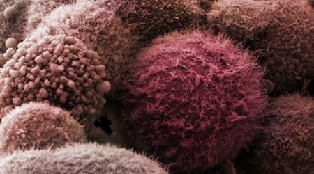 Major insight into killer pancreatic cancer