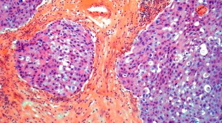 Terminal breast cancer could be wiped out by tweaking an EXISTING treatment