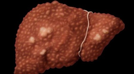 Viral hepatitis 'kills as many as Aids or TB'