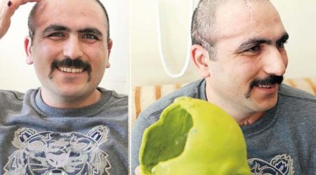 Aprel döyüşündə yaralanan hərbçiyə süni baş qapağı qoyuldu - FOTO