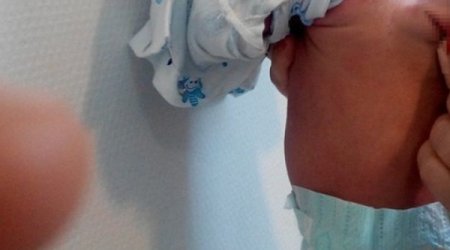 Azərbaycanda uşaq kürəyində cinsiyyət orqanı ilə doğuldu – FOTO