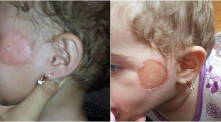 Bağçada uşağın üzünə dağ basdığı iddia edilən müəllimədən xəbər var