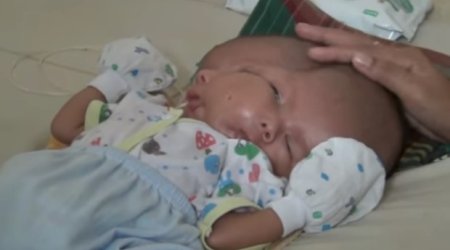 İki üzü olan körpə doğuldu – Video