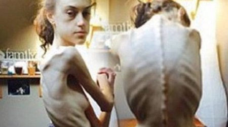 Pəhriz saxladı, bu hala düşdü -  FOTOLAR