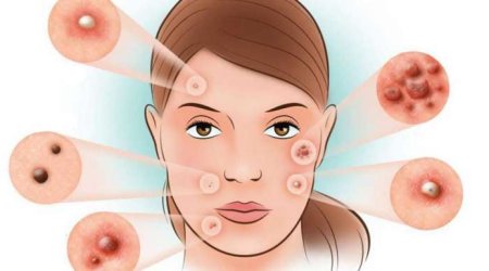 Bu sızanaqları sıxmayın - İflic Ola Bilərsiniz! - VİDEO