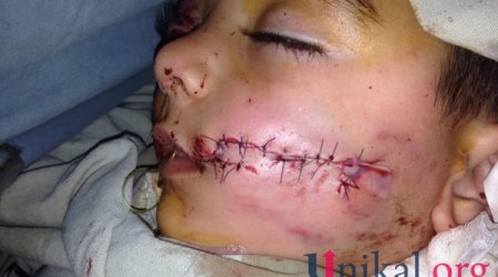 Sulutəpədə it 4 yaşlı uşağın üzünü parçaladı - FOTOLAR