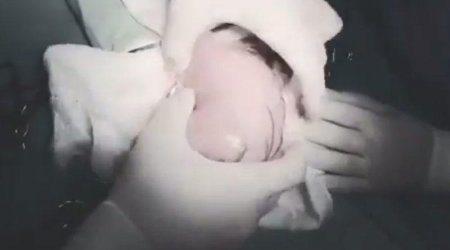 Azərbaycanda 5 yaşlı qızın mədəsindən böyük tük kütləsi çıxarılıb - VİDEO