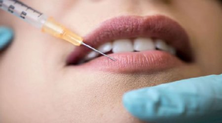 Azərbaycanda dodaqlarına dolğu vurduran qadının başına bəla gəldi - FOTO