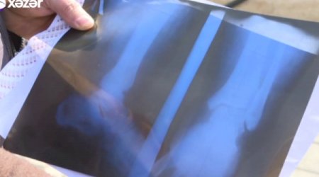Azərbaycanda həkim sınıq olmayan ayağa gips qoydu - Şok iddia - Video