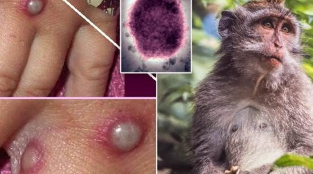 Meymunçiçəyi bu ölkədə də yayıldı