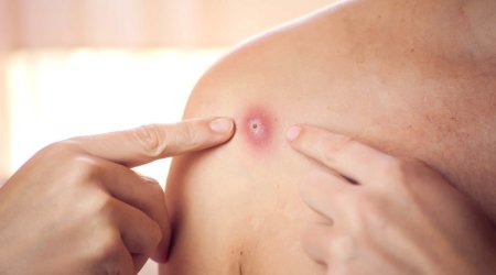 Britaniyada meymunçiçəyinə yoluxma sayı 106-ya yüksəlib