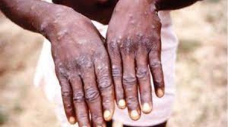 Meymunçiçəyi bu ölkəyə də çatdı