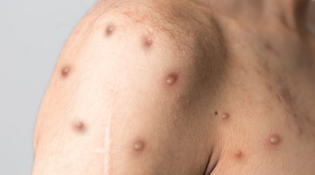 Daha bir Avropa ölkəsində meymunçiçəyi aşkarlandı