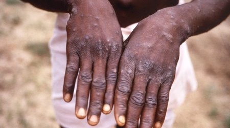 Bu ölkədə meymunçiçəyi aşkarlandı