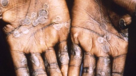 Meymunçiçəyinə qarşı peyvənd paylanacaq