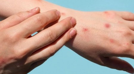 Rusiyada meymunçiçəyini aşkar edən test hazırlanıb