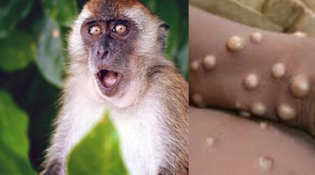 Bu şəhərdə meymunçiçəyi ilə bağlı fövqəladə vəziyyət elan edildi