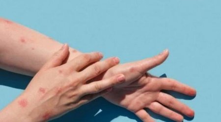 Bu ölkədə meymunçiçəyinə ilk yoluxma qeydə alındı