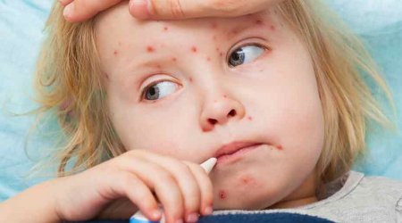 Ermənistanda qızılcaya yoluxma halları artıb