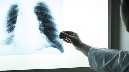 Polşada legionella bakteriyasından ölənlərin sayı artıb