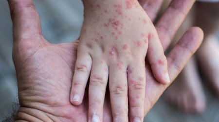 Ermənistanda qızılcaya yoluxanların sayı artıb