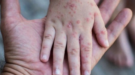 Qızılcaya yoluxanların sayında 79% artım var - ÜST