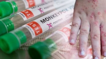 Afrikada meymunçiçəyi epidemiyası sürətlə yayılır