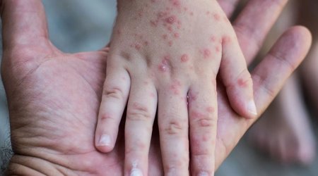 В Азербайджане заболеваемость корью резко снизилась