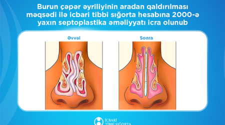 İcbari tibbi sığorta ilə 2000-ə yaxın burun çəpəri əməliyyatı icra olunub