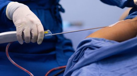 В Сумгайыте 34-летняя женщина скончалась после липосакции