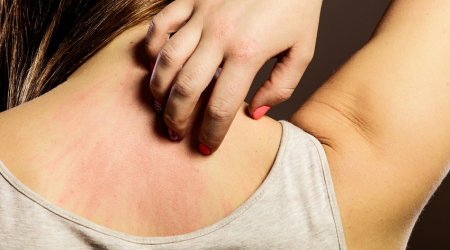 В Британии разразилась эпидемия необычной чесотки