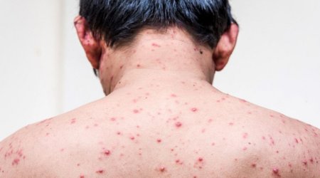 В Азербайджане зафиксирован рост числа заболевших ветряной оспой