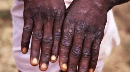 Meymunçiçəyi virusundan ilk ölüm faktı qeydə alınıb