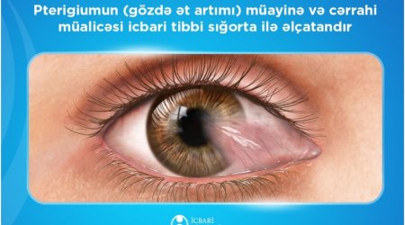 Pterigiumun cərrahi müalicəsi üzrə 2 minə yaxın əməliyyat icra olunub – İTSDA