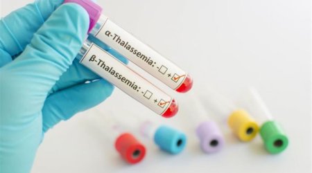 Bəzi talassemiya hallarında yeganə tam müalicə üsulu sümük iliyi transplantasiyasıdır