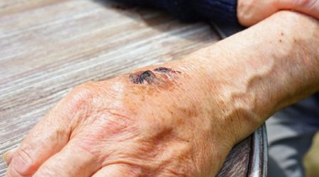 В Азербайджане в прошлом году число заразившихся сибирской язвой увеличилось