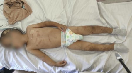 Valideynləri tərəfindən döyülən körpəsüni nəfəs aparatına qoşuldu