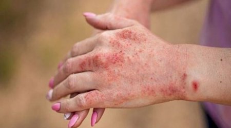 В Бангладеш от лихорадки денге за сутки умерли 12 человек